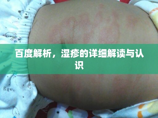 百度解析，湿疹的详细解读与认识